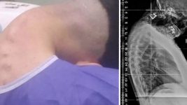 23-Year-Old Man Battles Addiction, Stricken by Rare ‘Dropped Head Syndrome’