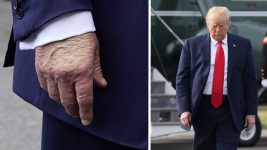 Donald Trump’s Chronic Condition Explained After Swelling Was Discovered on His Legs