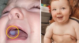 Stunned Doctors Thought Baby Had a Mouth Tumour Until a Surprising Twist Changed Everything