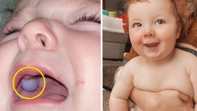 Stunned Doctors Thought Baby Had a Mouth Tumour Until a Surprising Twist Changed Everything