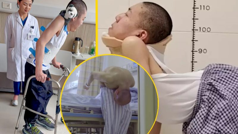 Boy Once Known as ‘Folded Child’ Stands Tall After Life-Changing Surgery